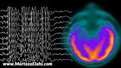 امواج مغزی,امواج آلفا- کنترل امواج مغزی - تنظیم امواج مغزی - تقویت امواج مغزی